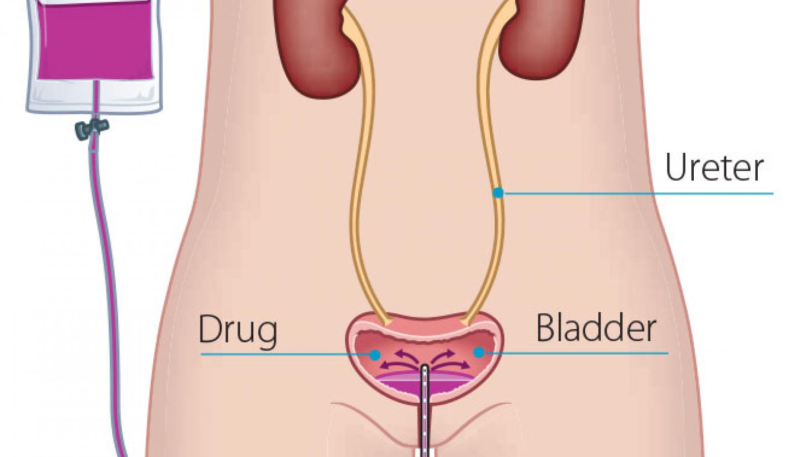 Giving drugs into the bladder