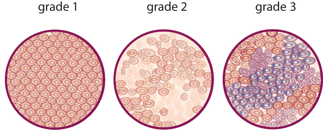 Cancer grading diagram