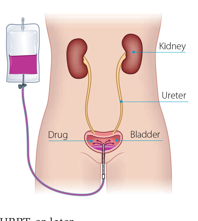 Liquid chemotherapy treatment for bladder cancer