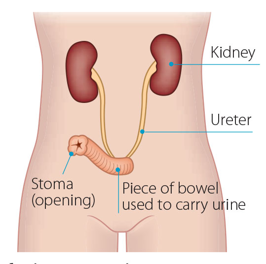 Urostomy diagram