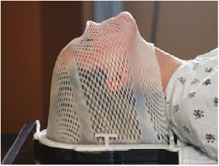 Patient using head radiotherapy mask