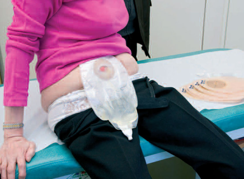 Picture of a patient with a urostomy