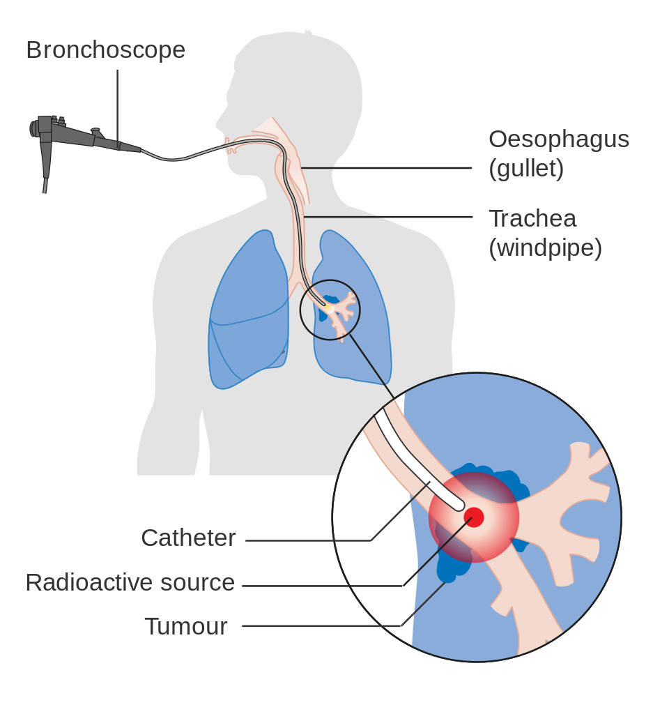 internal_radiotherapy_for_lung_cancer