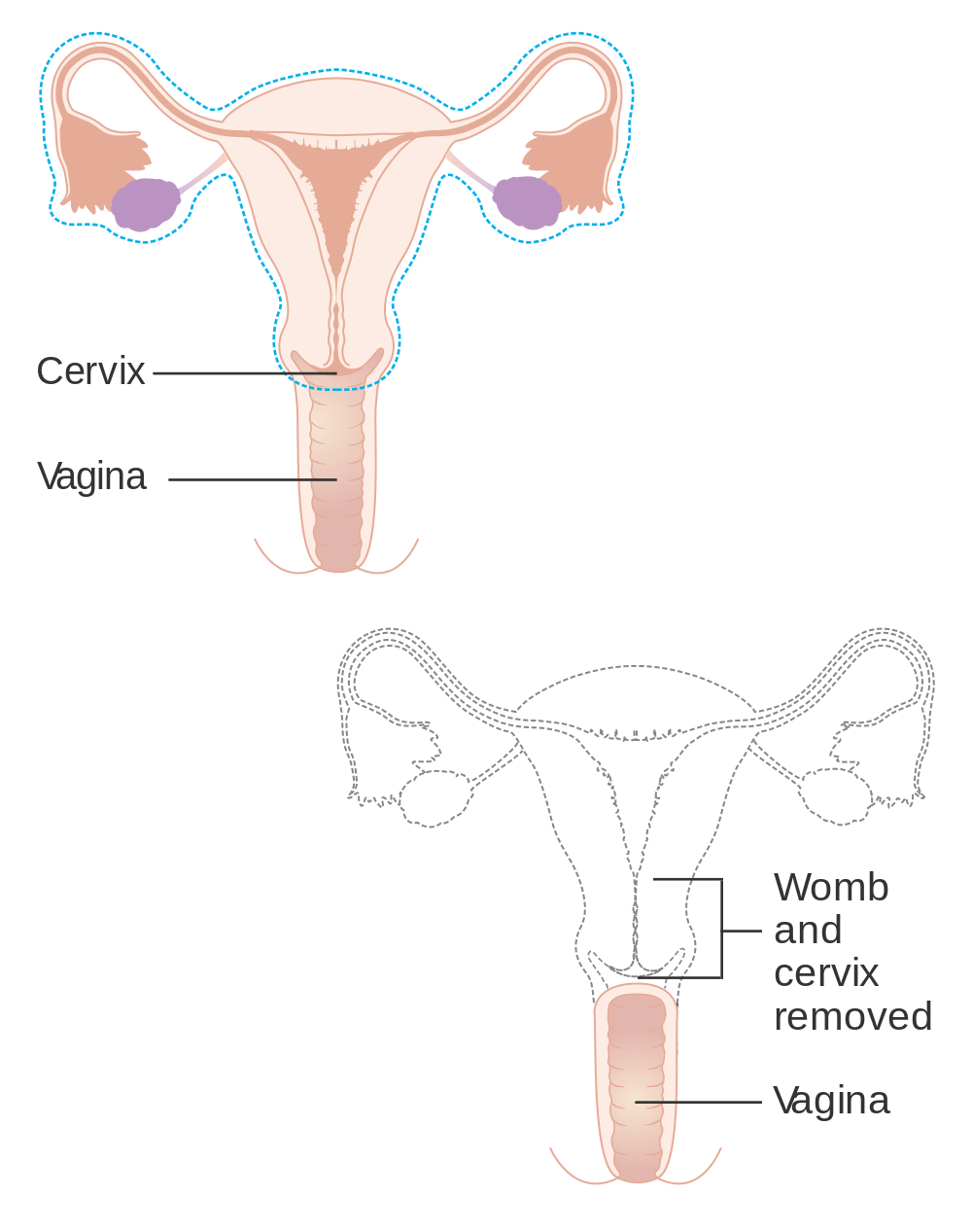 Diagram_showing_parts_of_the_body_removed_with_a_radical_hysterectomy