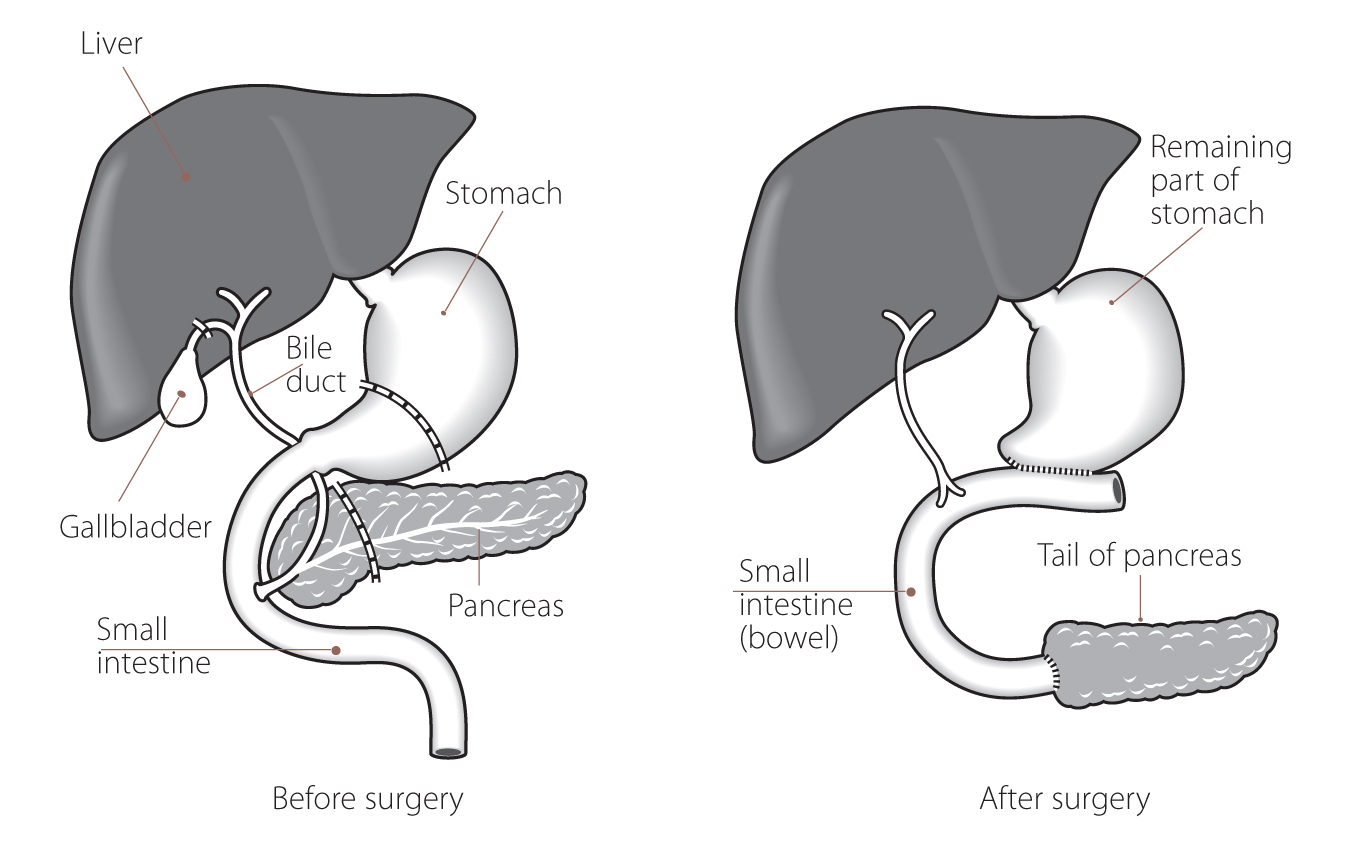 Whipple pancreas