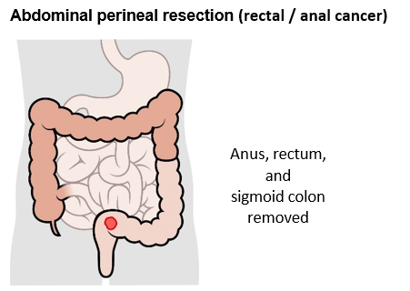 abdominal perineal resection