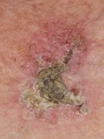 Actinic keratosis