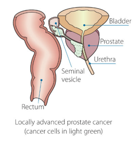 advanced prostate cancer