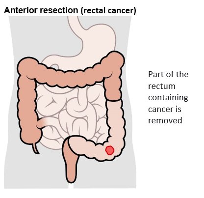 Anterior resection rectal cancer