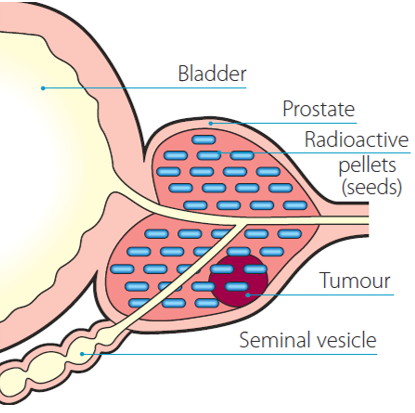 brachytherapy