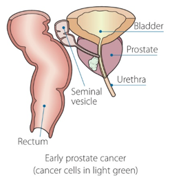 early prostate cancer