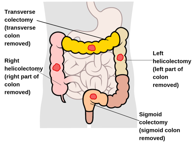 Types Of Surgery For Colon And Rectal Cancer | Irish Cancer Society