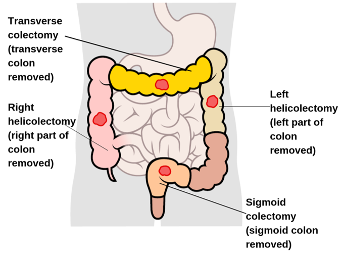 colon and rectal cancer surgery types