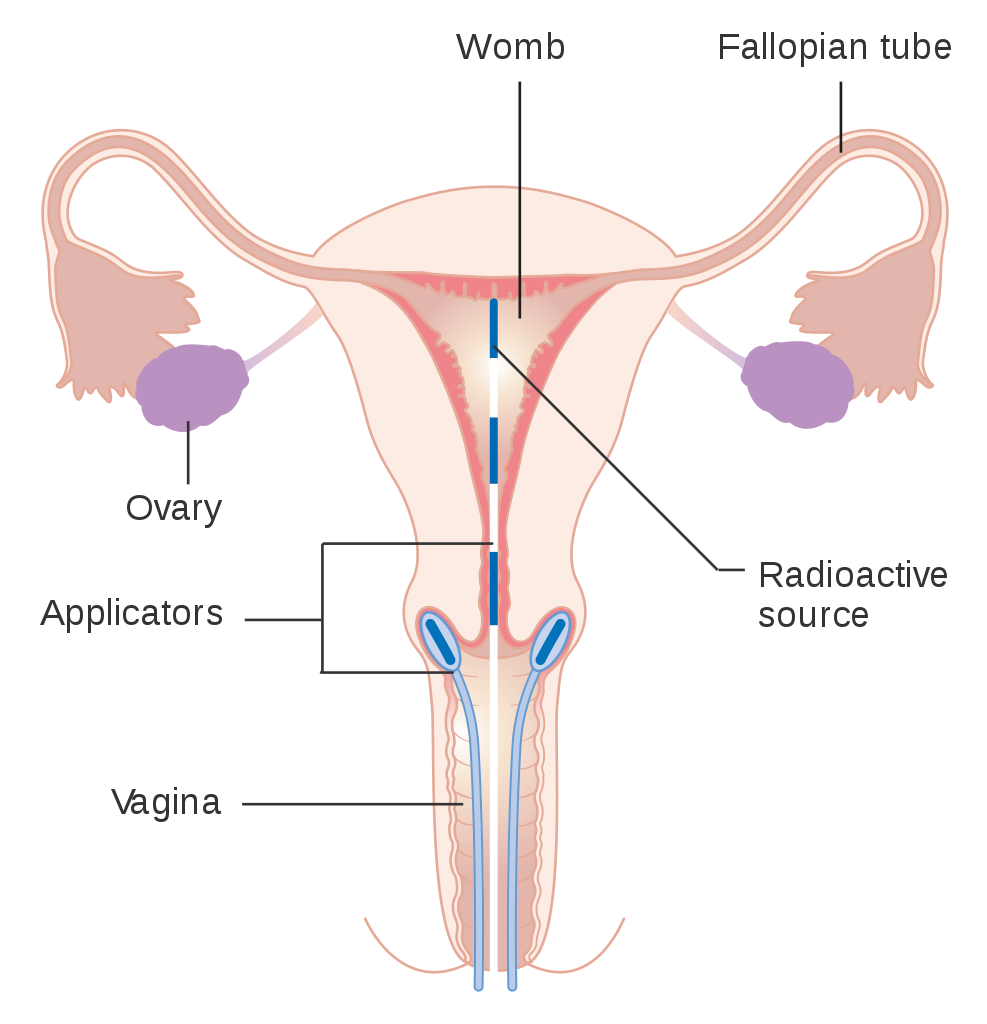 brachytherapy radiotherapy cervical cancer