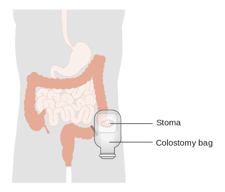 Colostomy diagram