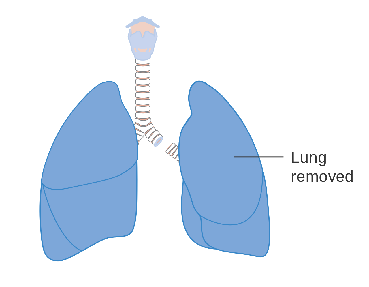 pneumonectomy lung