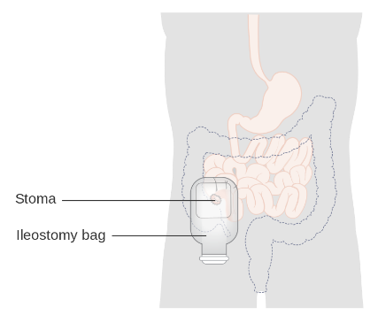 Ileostomy diagram