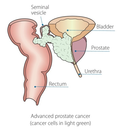 metastatic prostate cancer diagram