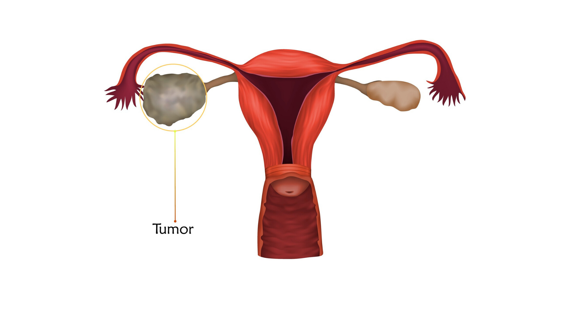ovarian cancer diagram
