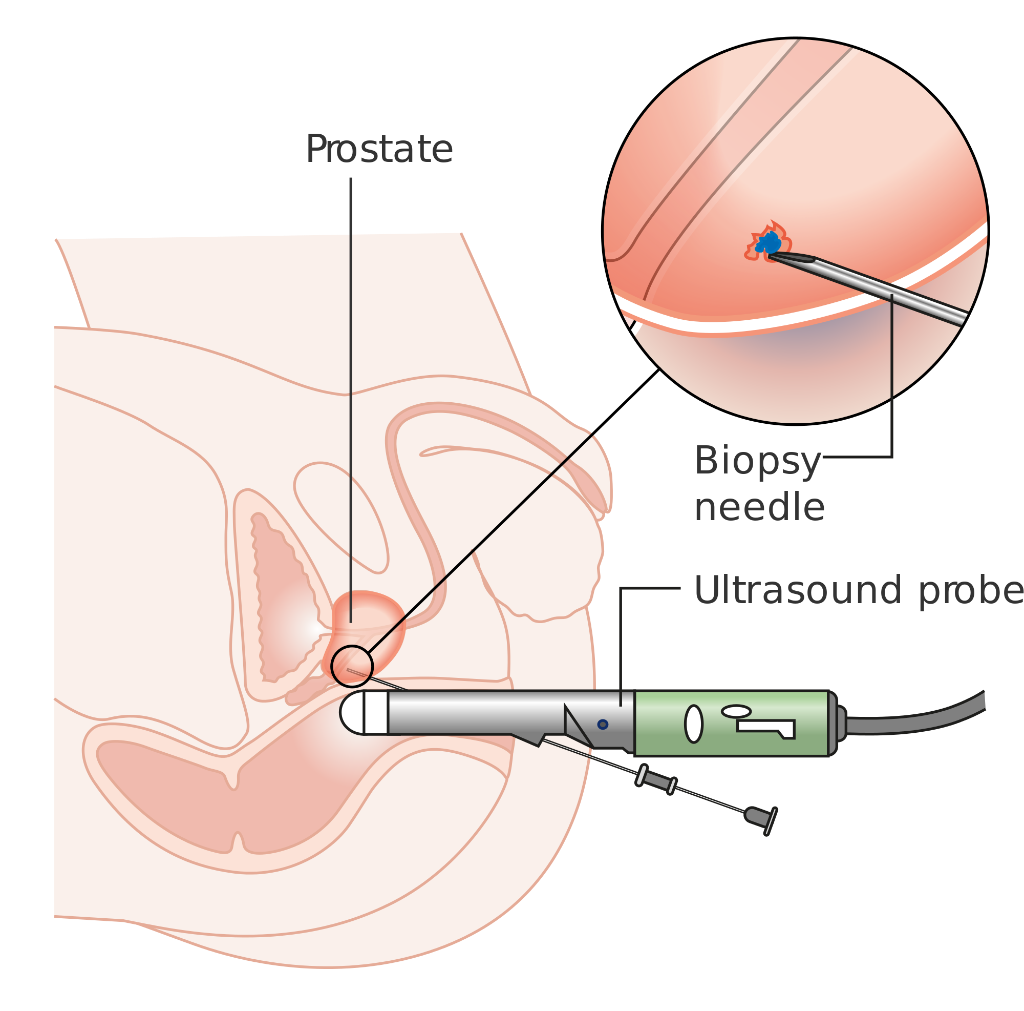 prostate biopsy