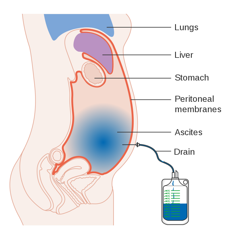 DIagram showing a cross section of a tummy with a build-up of fluid (ascites) being drained into a bag through a needle.