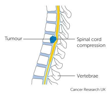 spine compression hernia cruk