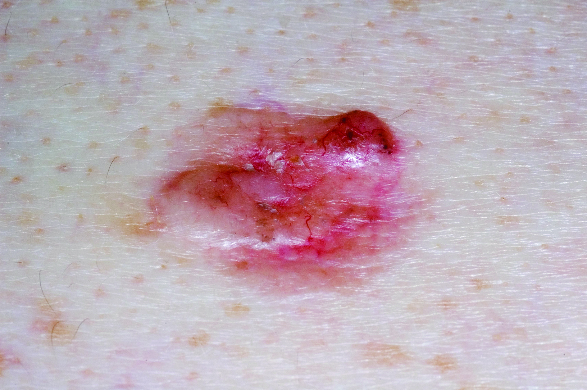Image of basal cell carcinoma