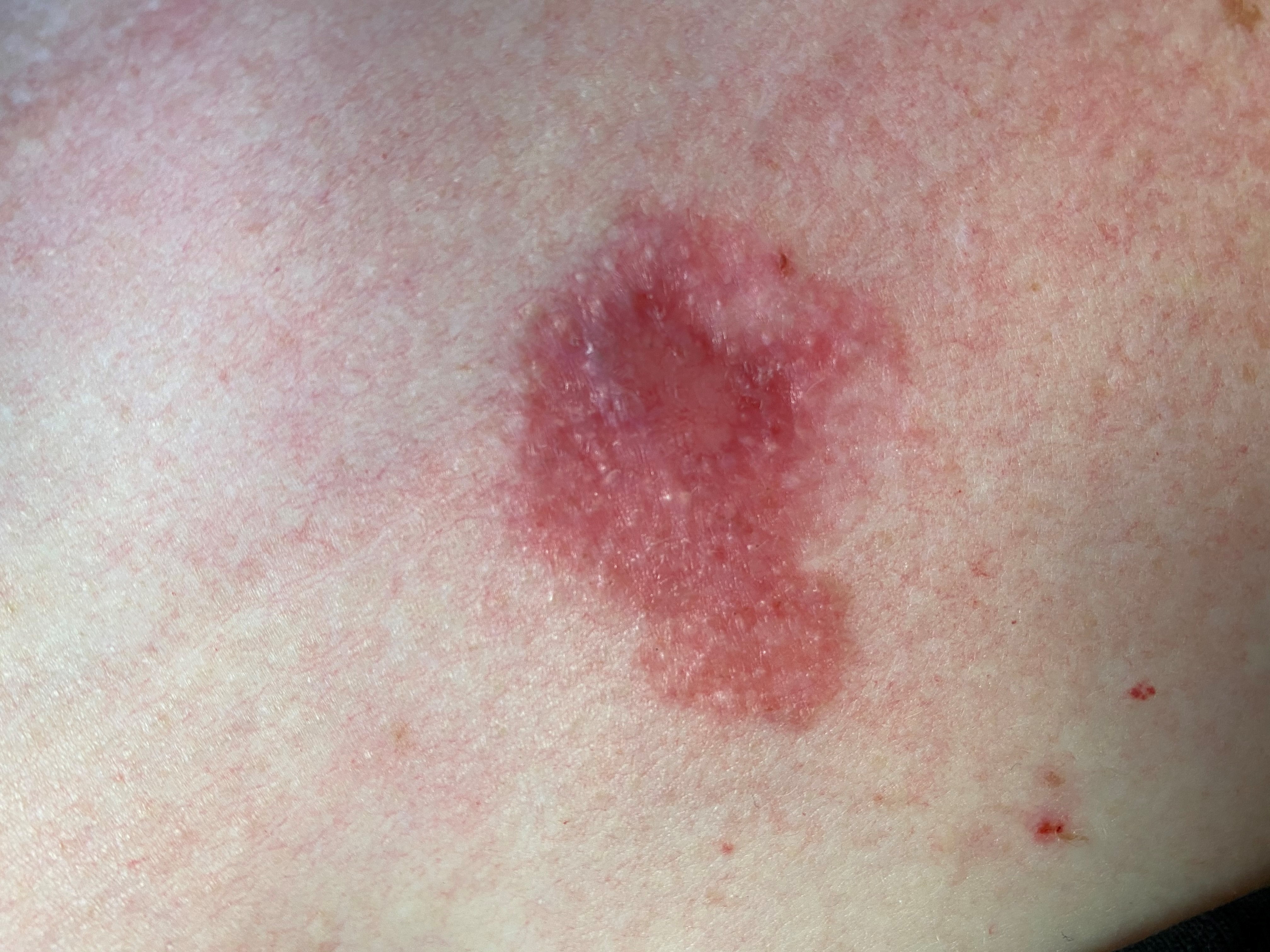 Image of basal cell carcinoma
