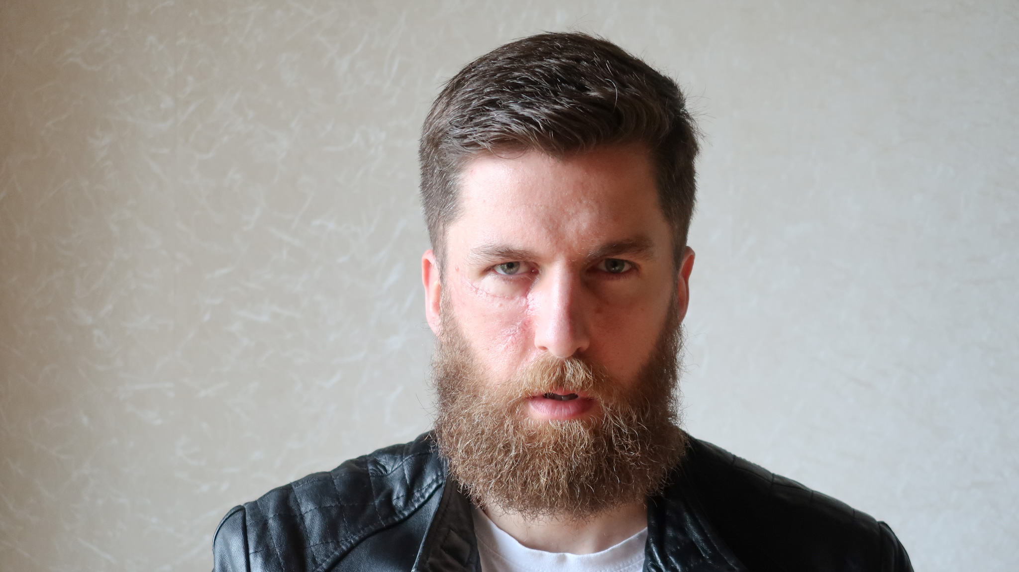 'These images show the reality of not wearing sunscreen' - skin cancer survivor James