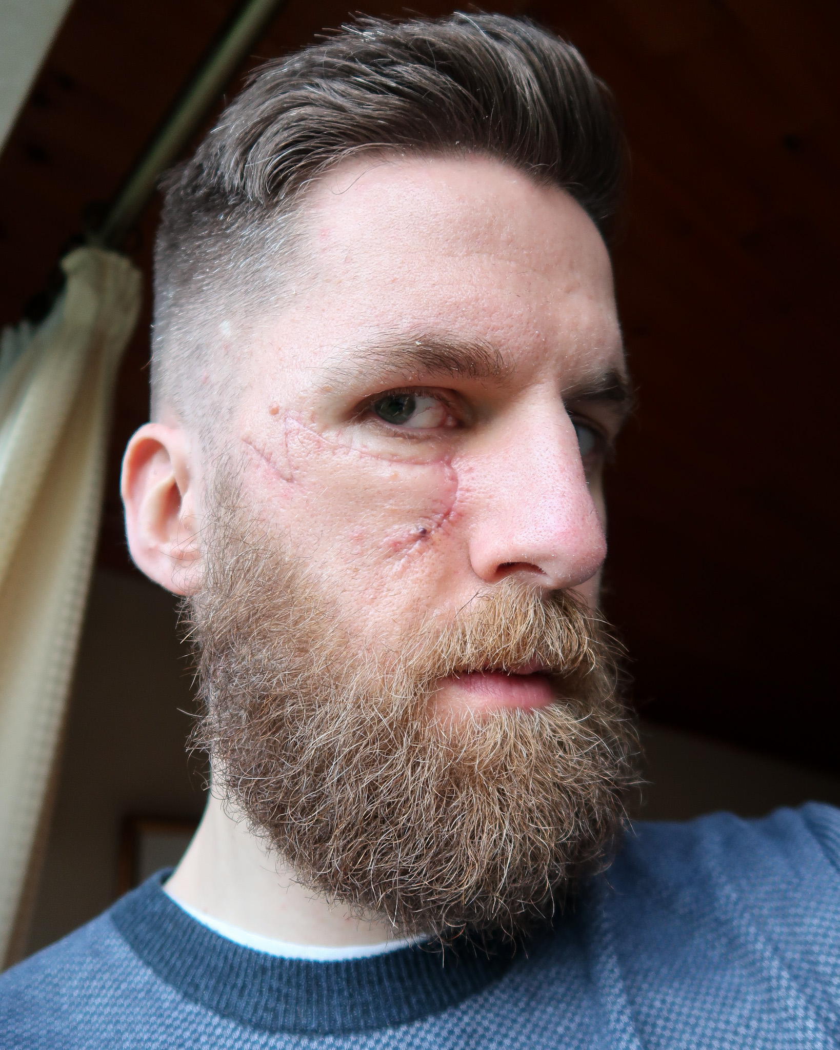 James Anthony's Skin Cancer Story 