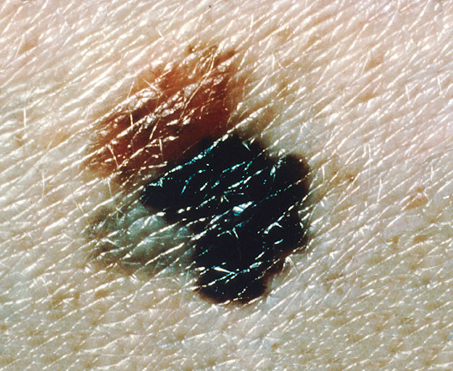 Image of melanoma skin cancer