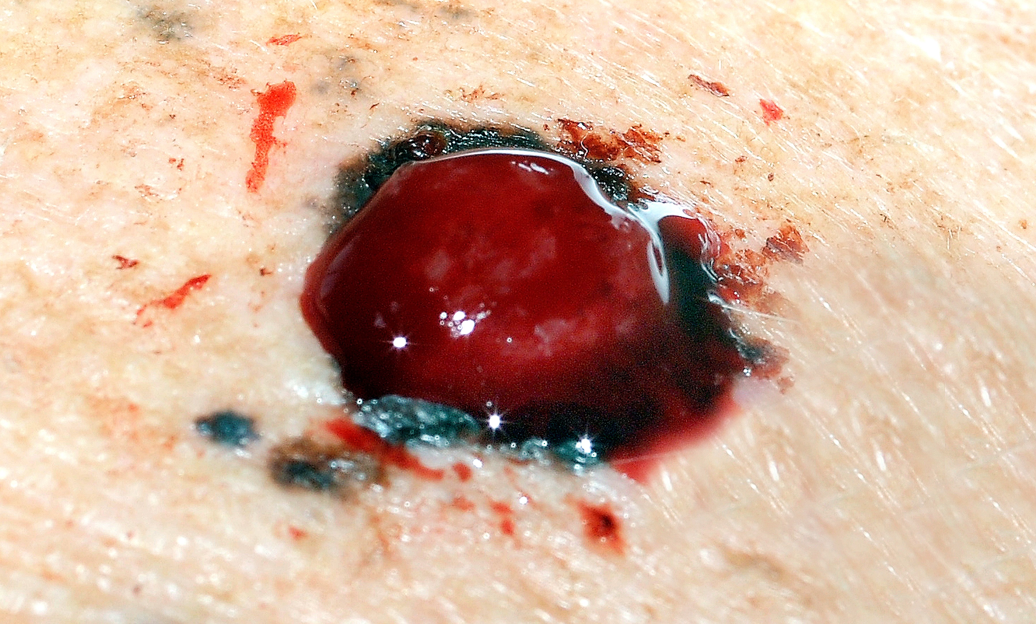 Image of nodular melanoma
