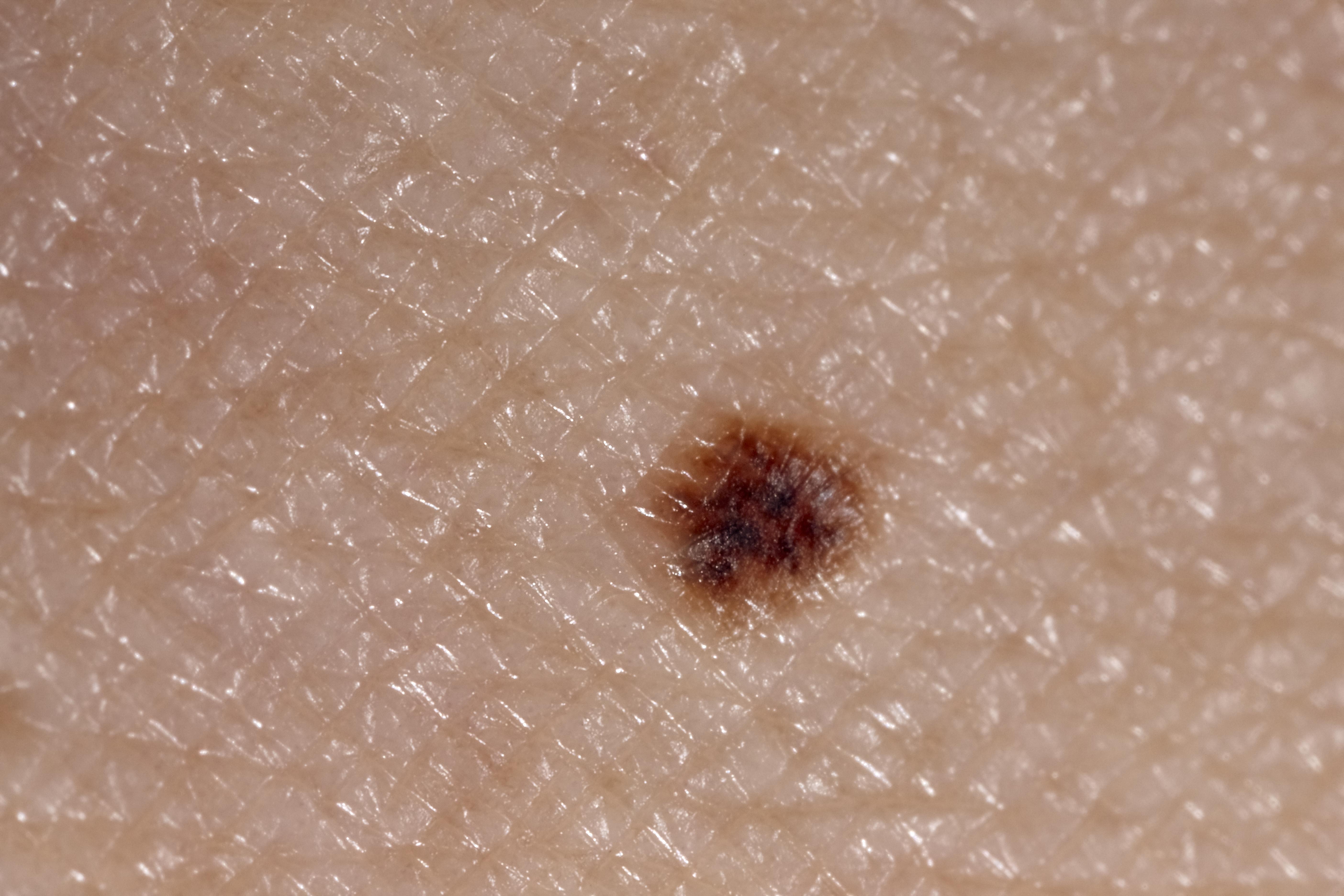 Image of melanoma skin cancer