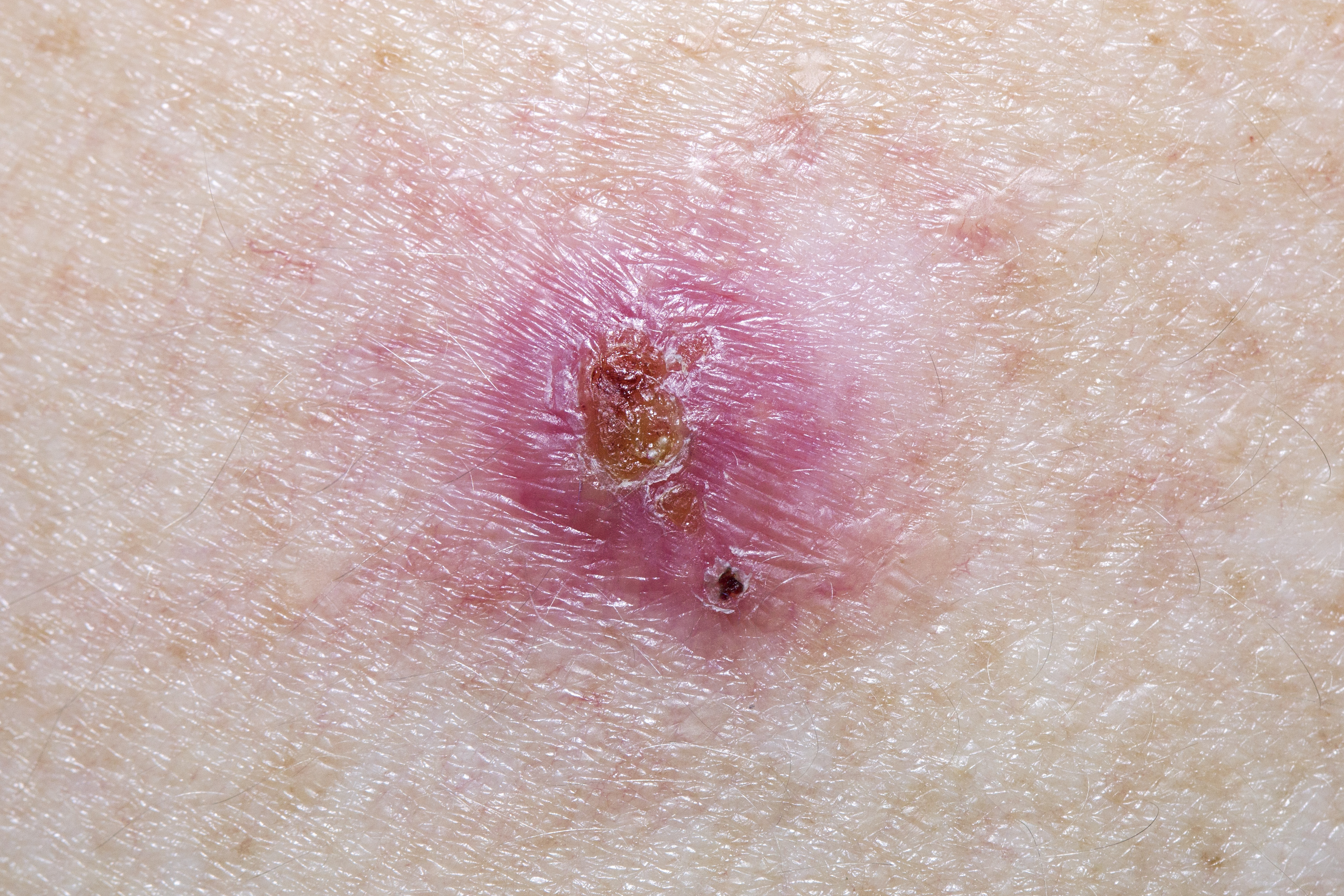 Image of basal cell carcinoma