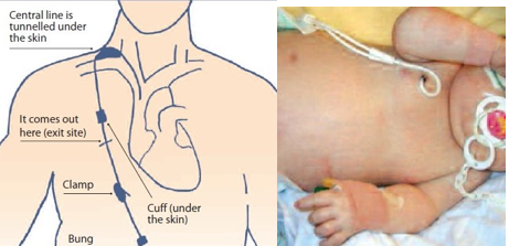 central lines for children