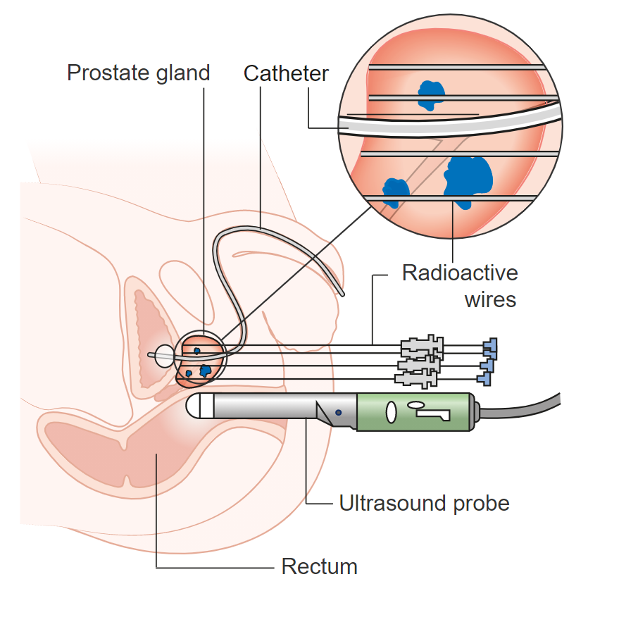 Brachytherapy