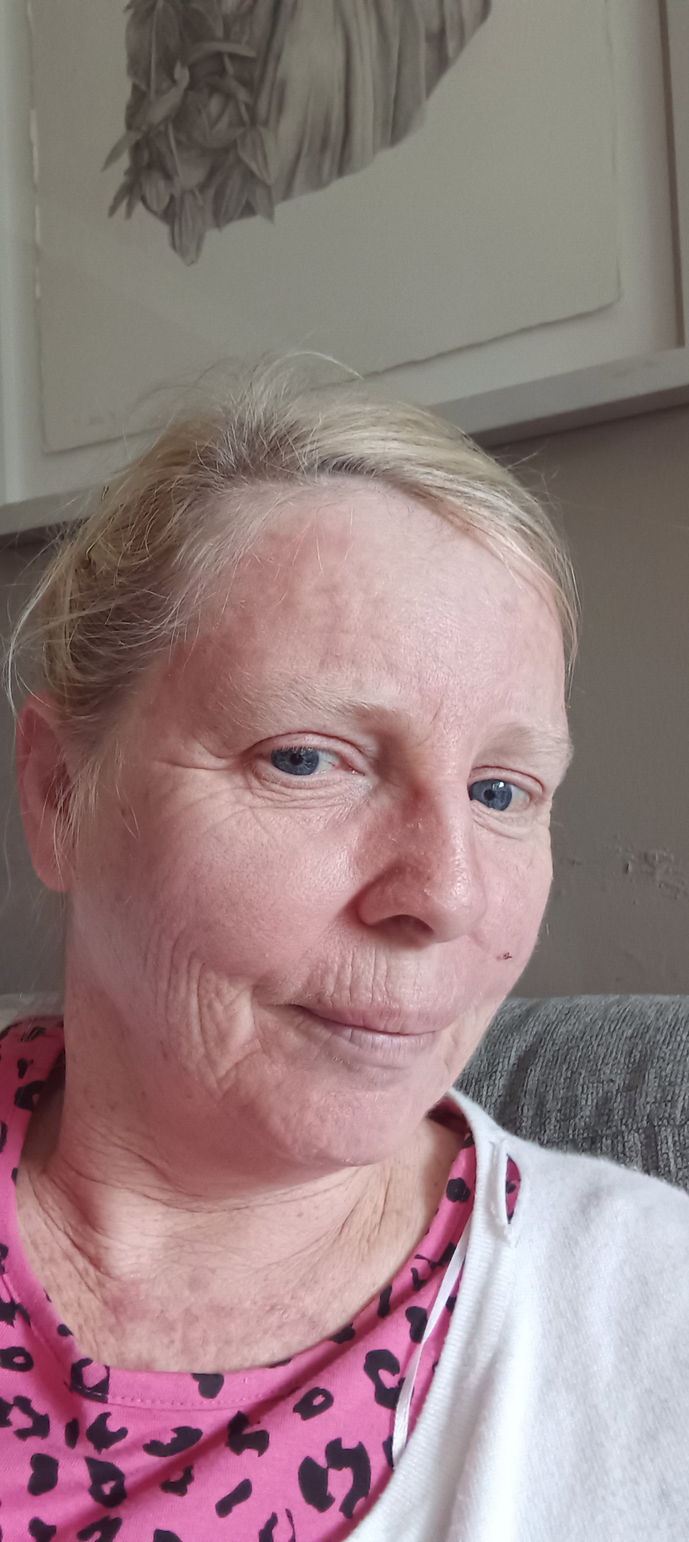 “That’s why I want to tell my story, not to scare people, but to show people the reality of living with skin cancer, the treatment and recovery process, and to encourage people to exercise caution in the sun” - Deirdre's story
