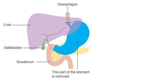 Diagram of the digestive system, showing how the stomach is removed in a gastrectomy