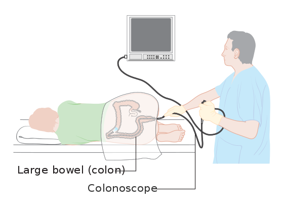An illustration of a man lying on his side with a doctor looking at a screen. The man has a tube with a camera n his back passage which is looking at his bowel. his bowel