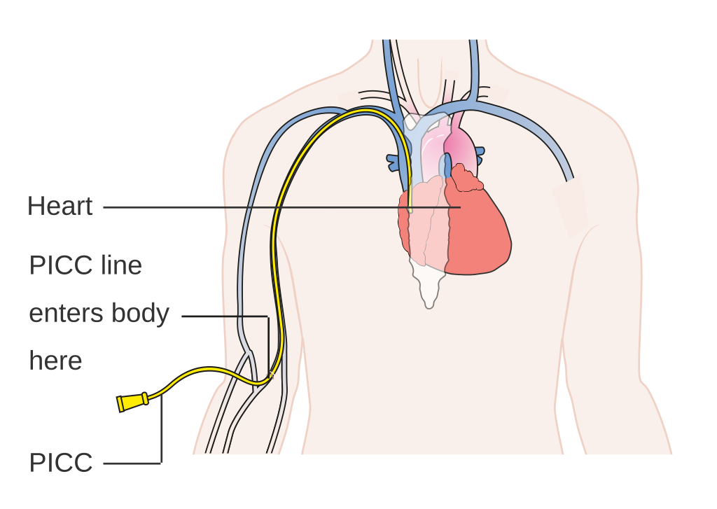Diagram of a PICC line showing the line entering the body and the other end of the line that can connect to a syringe