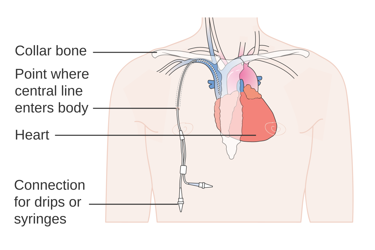 Diagram showing a central line entering the body and the connection for drips and syringes on the outside