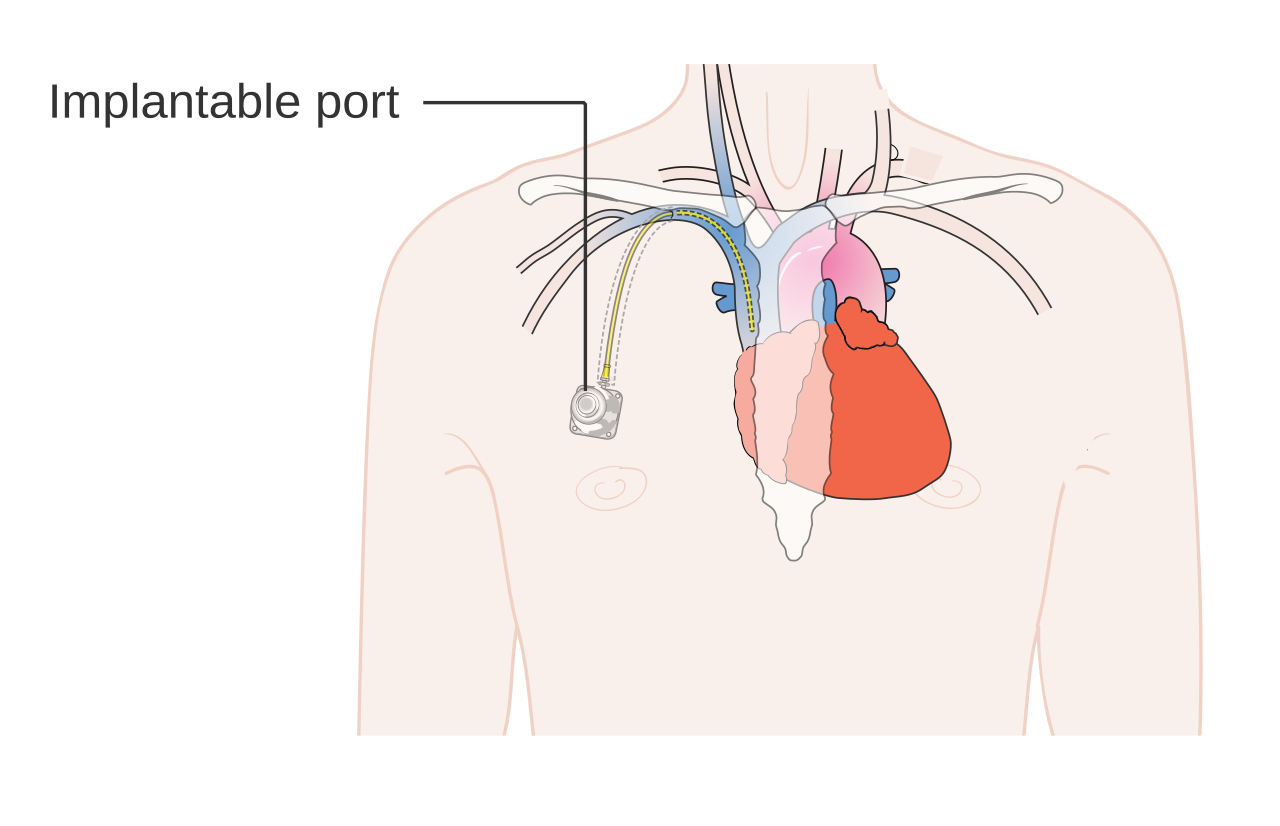 Diagram showing an implantable port under the skin near the heart.
