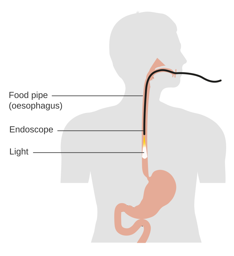 A diagram showing a tube going into a person's oesophagus