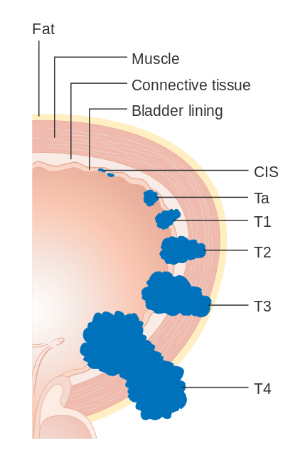 A drawing showing a cross section of a bladder and how tumours can grow on the surface of the lining or deeper into the muscle layers
