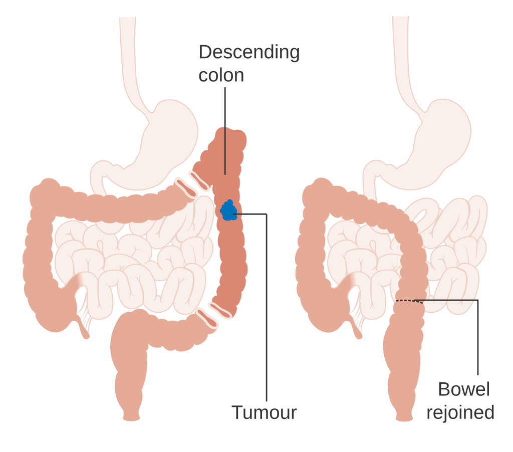 2 diagrams, one showing the part of a colon with a tumour in it and the other showing the tumour removed and the bowel rejoined.
