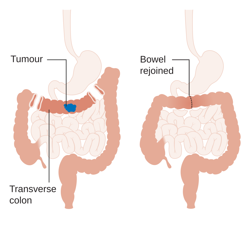 2 diagrams, one showing the part of a colon with a tumour in it and the other showing the tumour removed and the bowel rejoined.