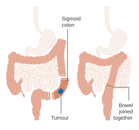 2 diagrams, one showing the part of a colon with a tumour in it and the other showing the tumour removed and the bowel rejoined.