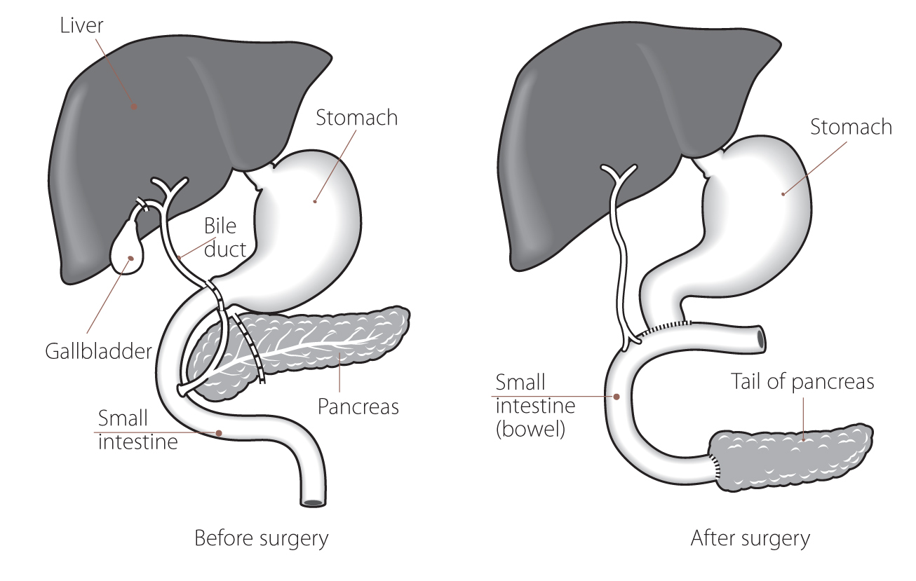 Pylorus preserving pancreaticoduodenectomy diagram