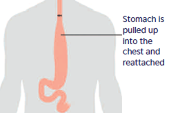 Diagram showing the digestive system after oesophagetomy surgery. The tumour in the oesophagus has gone and the remaining oesophagus is joined directly to the stomach.