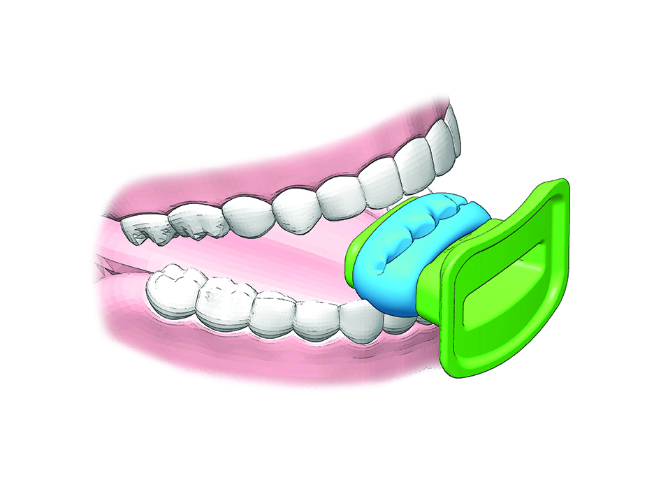 A dental mouth bite inside a mouth. The mouth bite is shaped like a dummy.